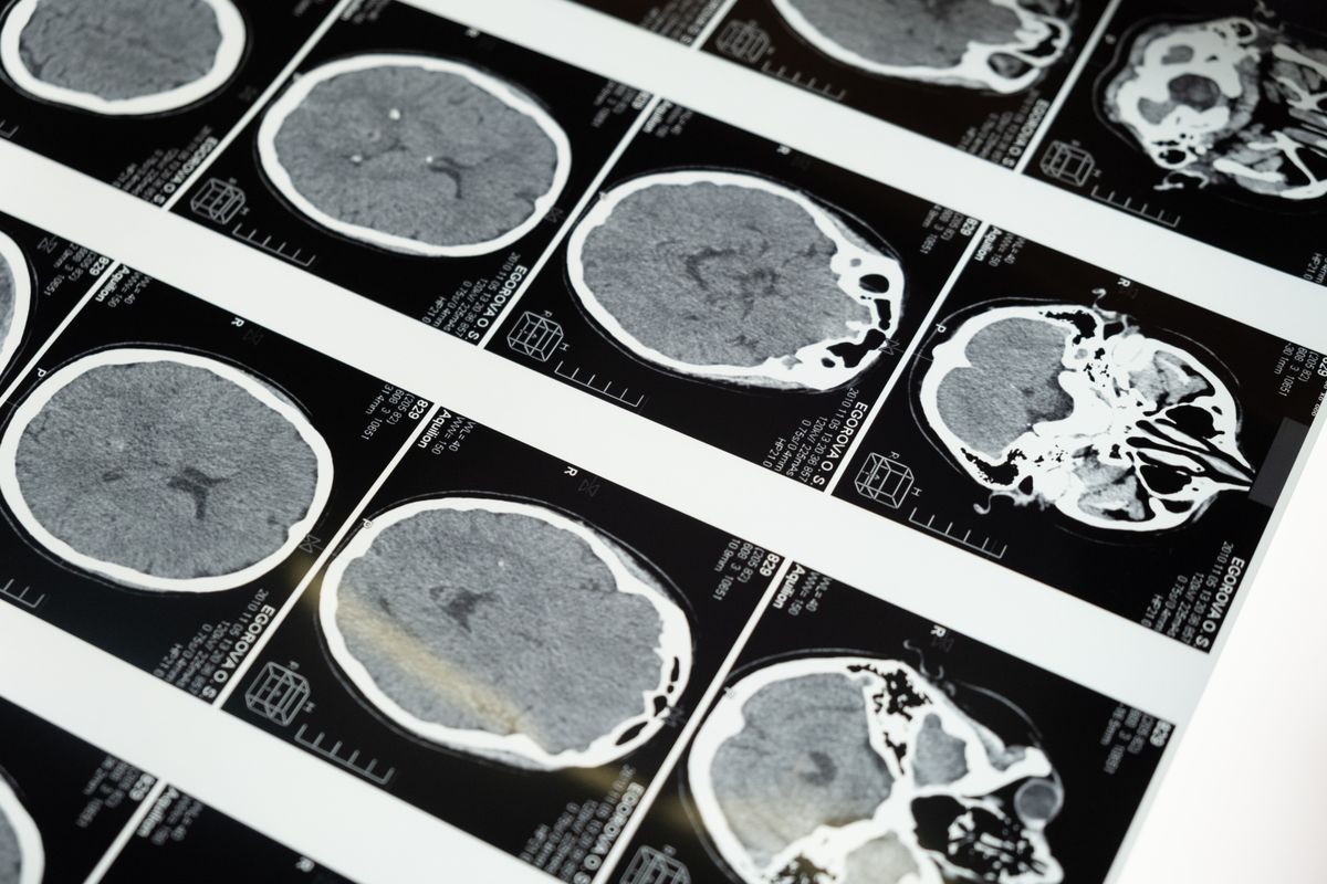 A sheet of brain scan images on a lightbox