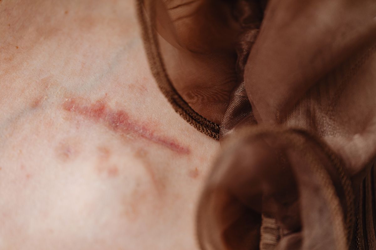 Close-up of a healed surgical scar on skin